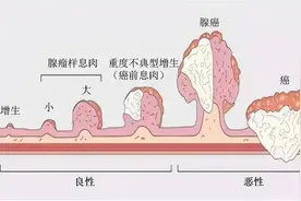 肠息肉切除就完事？医生提醒：警惕术后并发症图片