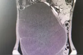 13岁女孩腹部增大以为是“长胖”检查发现巨大卵巢肿瘤图片