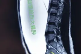 女孩误将腹腔肿瘤当发胖疯狂减肥，结果摘出多个畸胎瘤图片