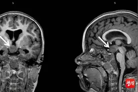 2岁女童患上罕见脑肿瘤莫名发笑，专家“立体定向消融”消灭肿瘤图片