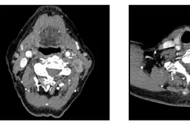 潍坊市第二人民医院普外科成功为八旬老人实施巨大甲状腺癌根治术图片