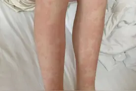 用了“神器”，浙江一女生全身发红、瘙痒难忍！医生提醒图片