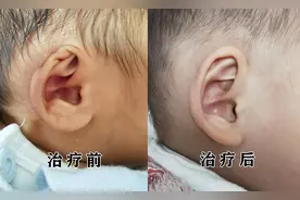 孩子出生时耳朵畸形怎么办？图片