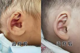孩子出生时耳朵畸形怎么办？图片
