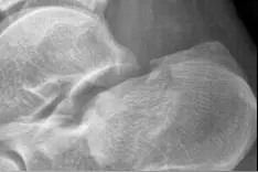 切口仅1厘米，螺钉固定精准到亚毫米级！关节镜机器人齐齐助力骨折手术图片