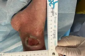 被蚊子叮咬后，脚踝烂个窟窿！几类人群务必要当心图片