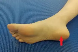 有了足底筋膜炎还能做运动锻炼吗？图片