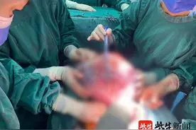 肚子变大可能不是长胖也不是怀孕……图片