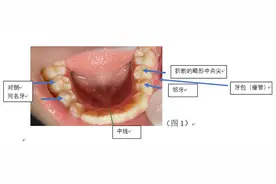 牙齿上有小尖尖？10到12岁的儿童要注意图片