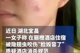 女客人投诉被害虫咬伤脸手，酒店回应“不是我们责任”图片