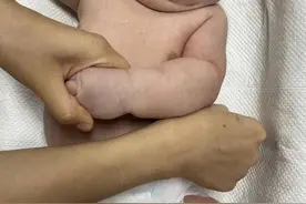 刚出生就10多斤重的“大胖小子”被紧急送医抢救 医生建议：应调节孕期饮食 严格控制血糖图片