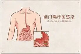 健康冷知识丨体检查出幽门螺旋杆菌感染 为什么一点症状都没有？图片