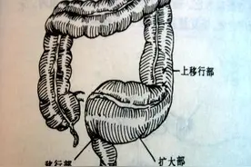 婴儿光吃不拉？原来是患先天性巨结肠图片