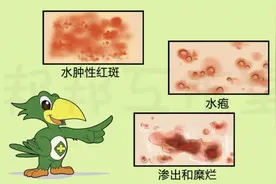 炎炎夏日，谨防这种皮肤病来扰图片