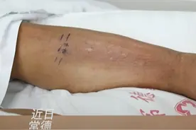 男子被蚊子咬了十几个包后，持续高烧患脓毒症进ICU图片