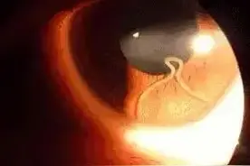 10岁女童眼睛里惊现长长的、白白的……吓人图片