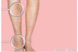 静脉曲张了，穿弹力袜管用吗？图片