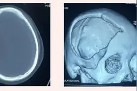 西安医学院一附院首次应用PEEK材料完成修补颅骨缺损术图片