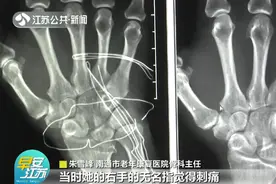 针头扎进女子手指，17年后竟穿过手掌从手腕取出！医生提醒图片