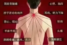什么是颈肩综合征 如何治疗图片