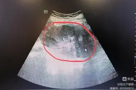 女子腹痛强忍3日险丧命，多学科团队术中明确病灶成功施救图片