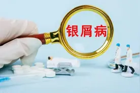 银屑病不仅仅是一种皮肤病，别再乱找偏方图片