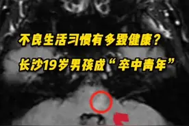 不良生活习惯有多毁健康？19岁男孩中风成为“卒中青年”图片