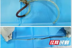 七旬老人“尿不出”自行导尿 半米长塑料管卡在体内打了死结图片