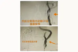 继往开来 永攀高峰——平度市第三人民医院神经内科再次成功完成两例脑血管支架植入术图片