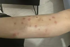 别人带回秀丽海南风光，我带回两腿红疙瘩？图片