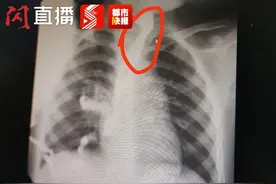 咋回事？西安3岁小孩吃饭老被噎 竟是两年前误吞的贴纸作祟图片