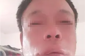 河北男子看蜜蜂授粉被蜇成“香肠嘴”，吃饭喝水都漏图片