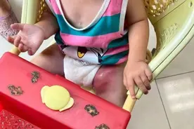 湖南一岁女童遭蚊子叮咬腿部肿成拳头大小 医生紧急手术抢救图片