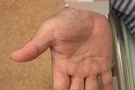 糖尿病患者出现手麻就是糖尿病神经病变？症结其实出在患者的睡姿上图片