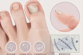 如何防治“灰趾（指）甲”？图片