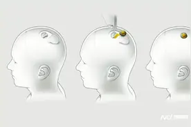 美国完成首例不开颅的人体脑机接口手术 术后48小时可出院图片