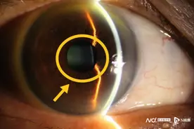 白内障、老花、近视、散光全纠正，九旬老人术后视力提升十倍图片