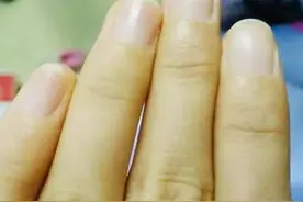指甲长竖纹、白斑、黑线...是“疾病征兆”？这些实情，现在知道还不晚图片