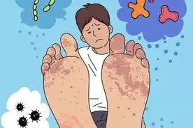 脚气和脚气病不一样图片