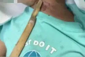 昨夜急诊 | 2岁宝宝被木棍插喉，差一点戳进颈动脉，随时可能要命……图片