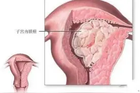 超声知识小科普：子宫内膜癌图片