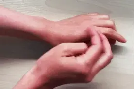 浙江55岁男子“手痒”2年，确诊这种癌图片