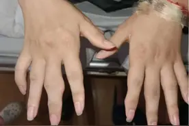 吓人！27岁小伙饮料当水喝，手脚都变形了！医生提醒图片