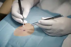 有些痣不“好惹”！冷冻祛了一颗痣，半年后长成癌图片