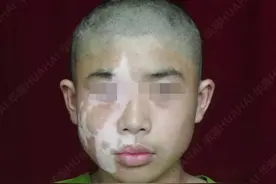 白癜风康复故事：医者仁心让14岁男孩重获新生图片