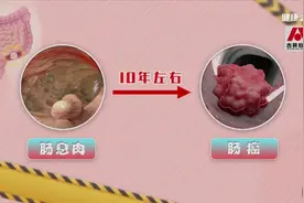 抗击癌症重在防！远离这些防肠癌图片