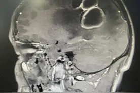 抽出5针筒水！小伙来杭州几天撑不住了...病因竟和家里的它有关图片