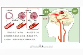 脑梗塞、脑血栓、脑栓塞的区别图片