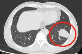 男子熬夜“累过头”，真菌溜进脑部引发感染图片