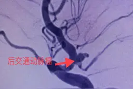 日照市中医医院：头痛、恶心、呕吐，当心“颅内动脉瘤”破裂图片